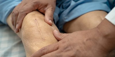 Asian senior or elderly old lady woman patient show her scars surgical total knee joint replacement Suture wound surgery arthroplasty on bed in nursing hospital ward, healthy strong medical concept.